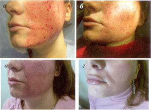 Fases da restauración da pel despois da ablación fraccionada