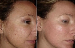 Rexuvenecemento facial láser antes e despois das fotos